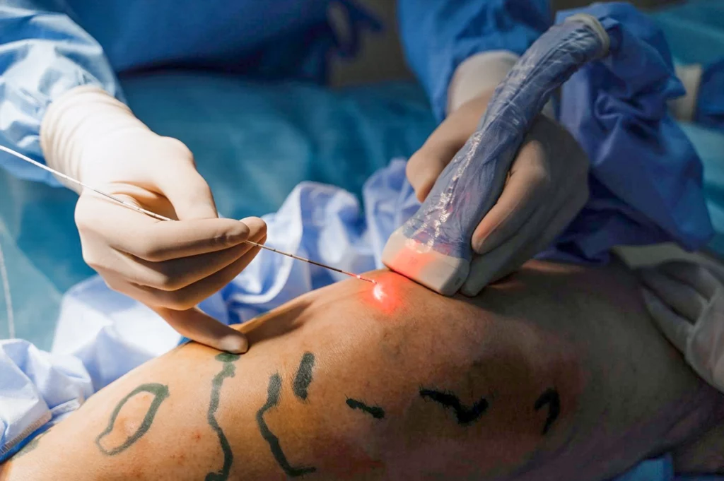 Małoinwazyjne metody operacji żylaków