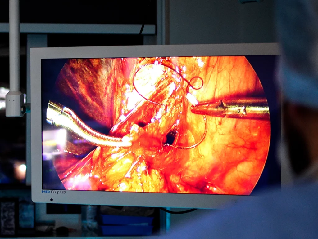 Przepuklina pachwinowa