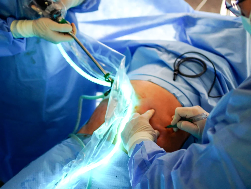 Przepuklina pachwinowa