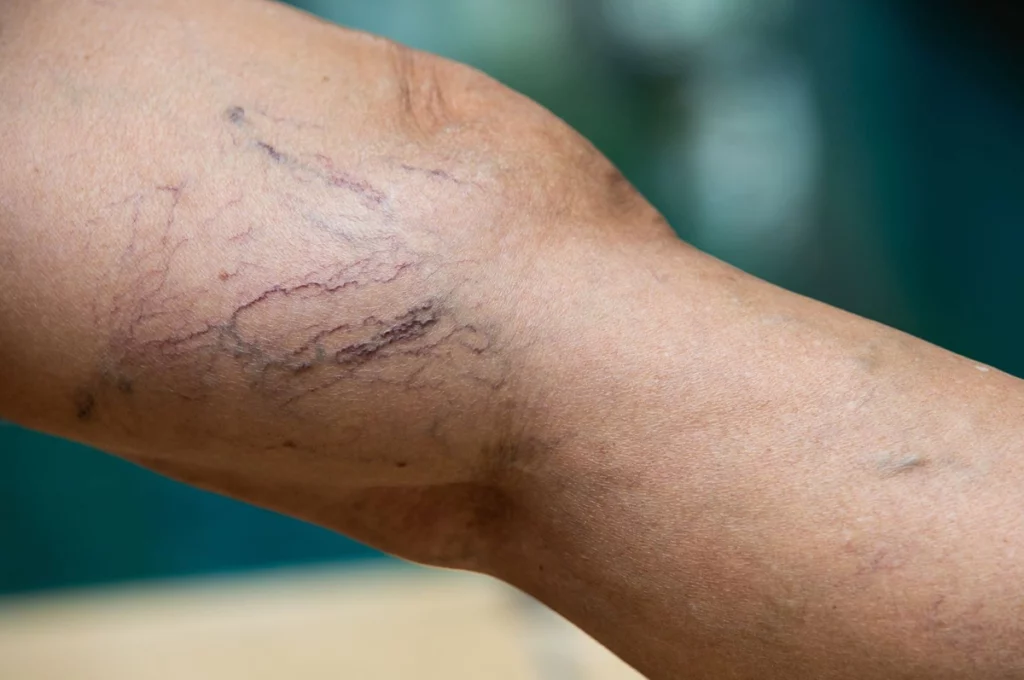 Tradycyjne metody operacji żylaków