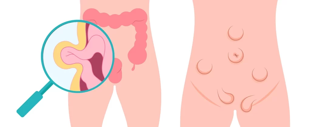 Przepukliny pępkowe