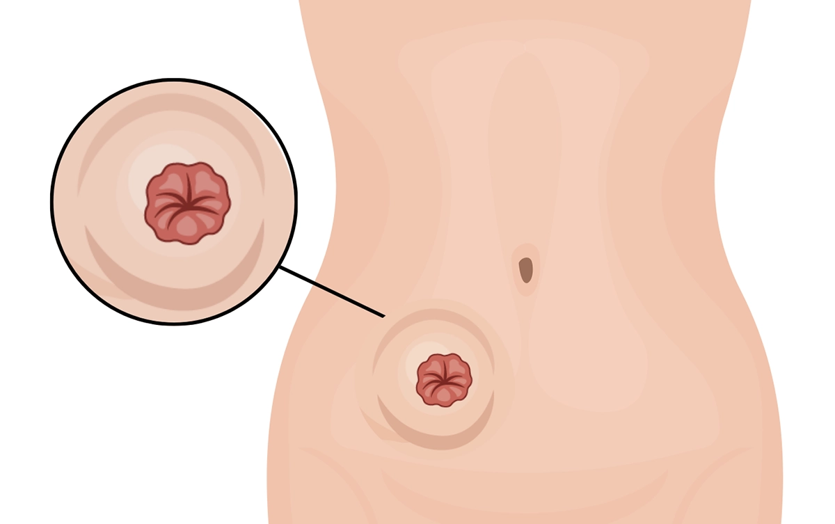 Przepuklina okołostomijna