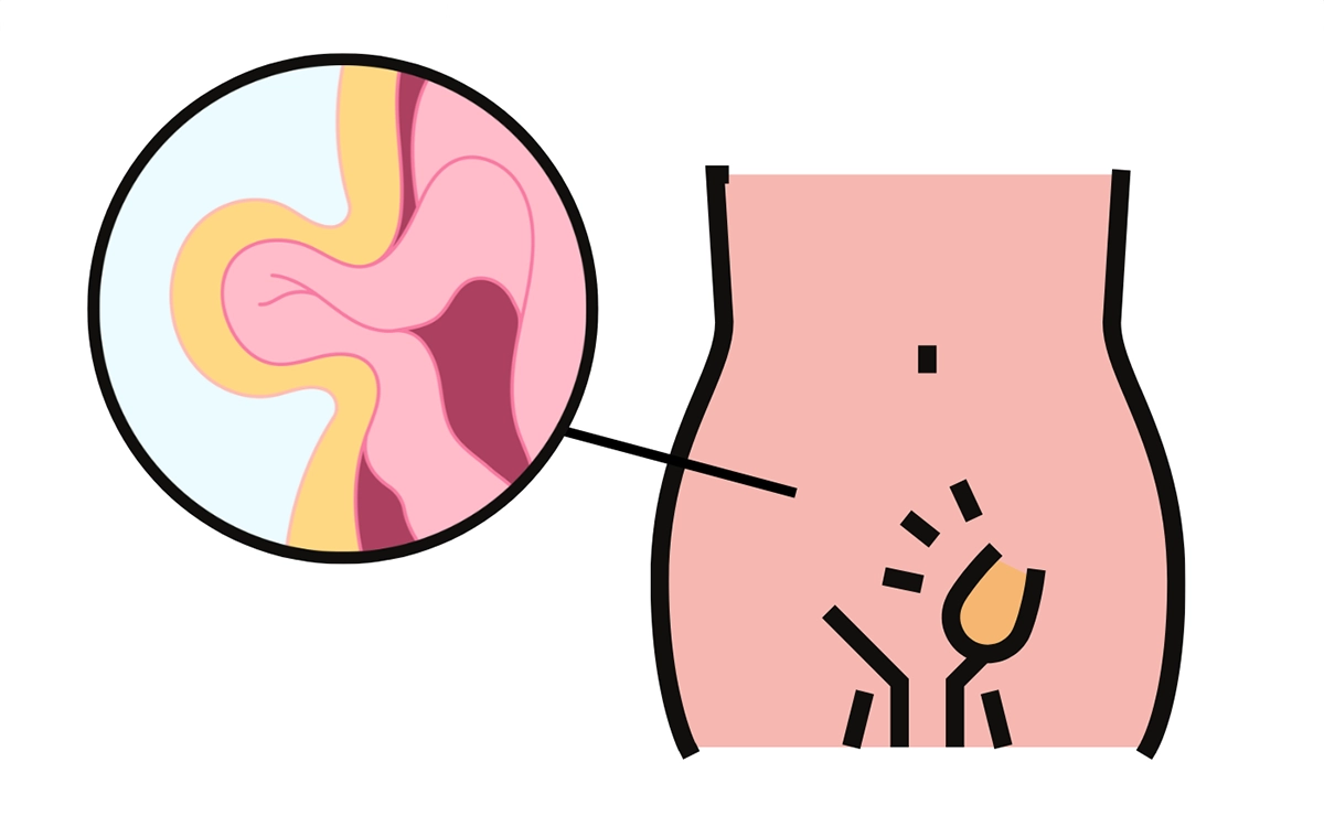 Przepuklina pachwinowa