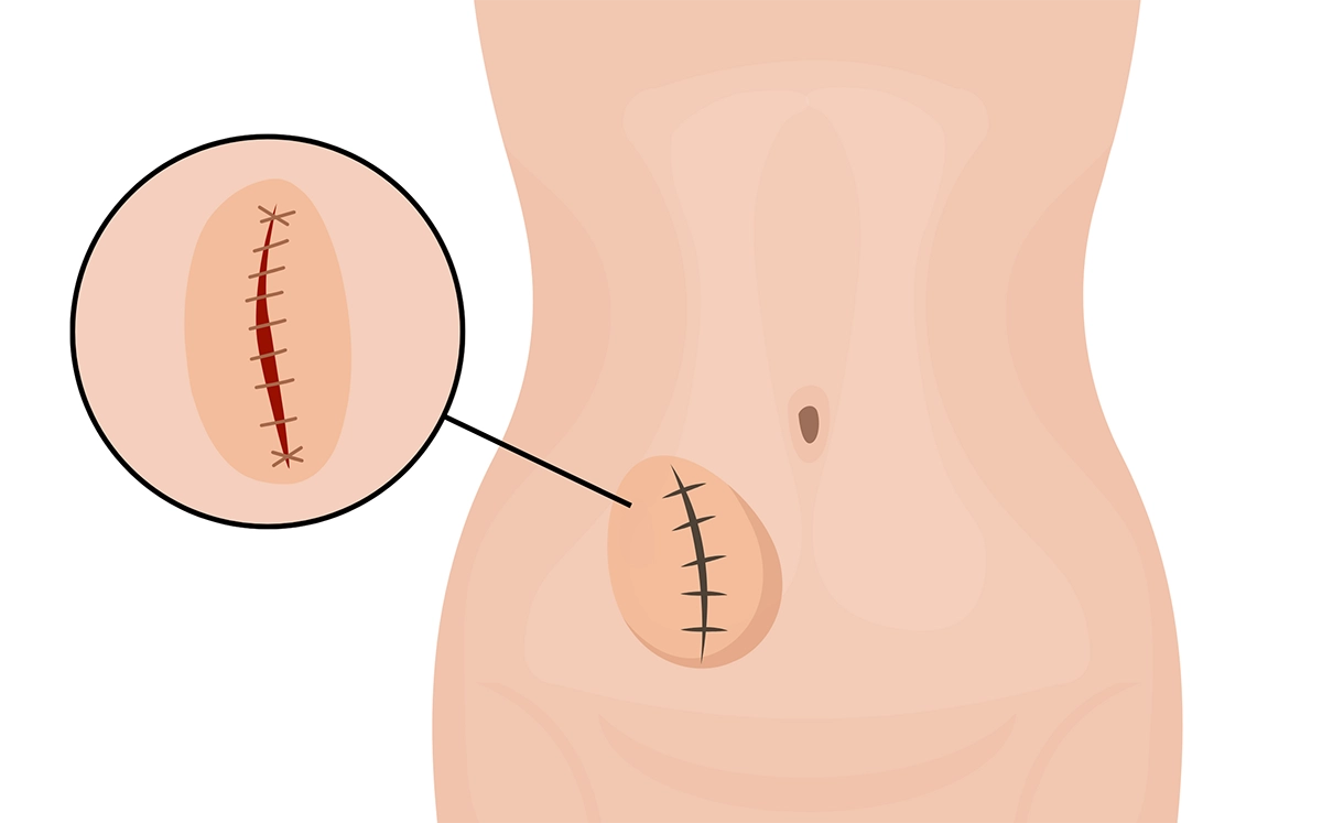 Przepuklina pooperacyjna