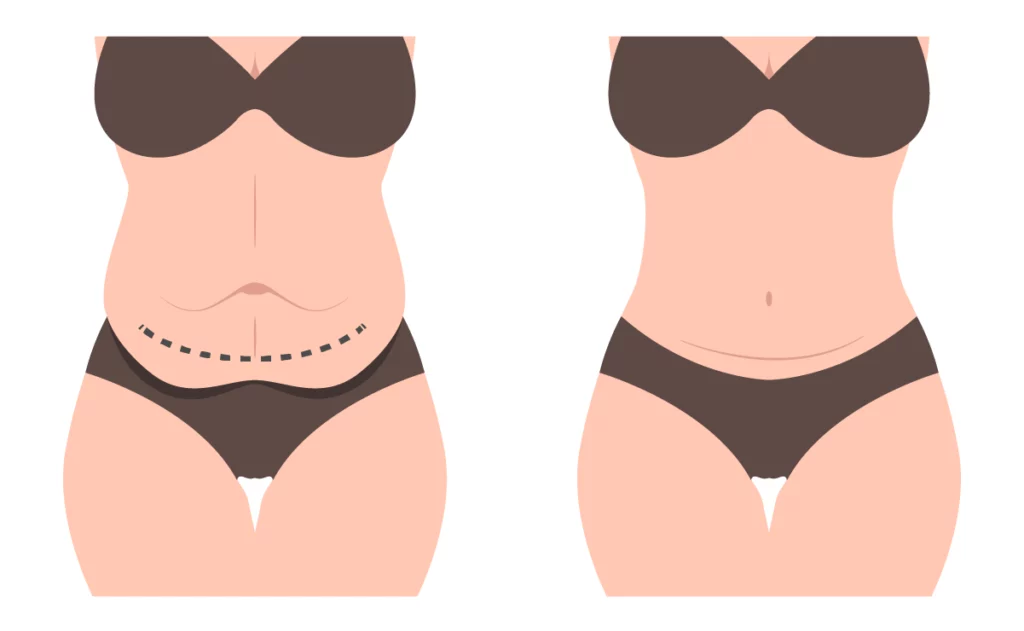 Abdominoplastyka brzucha